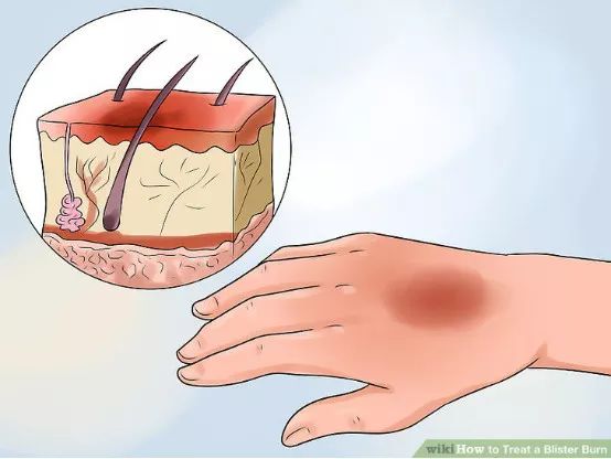 跑步脚上起水泡怎么处理好得快,脚跑步起水泡怎么处理好得快