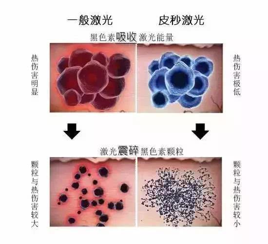 体验分享｜坐着高铁，带着妈妈去香港打皮秒