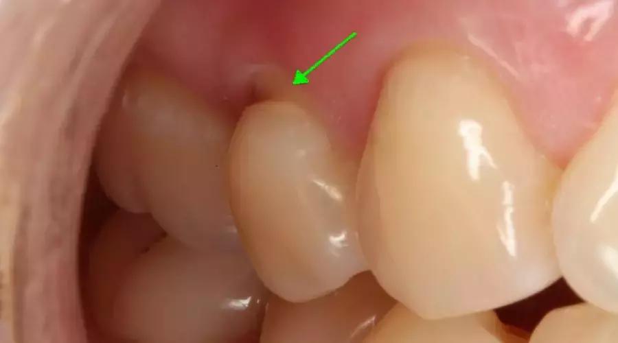 牙齿顶端小凹槽,牙齿出现楔状沟槽