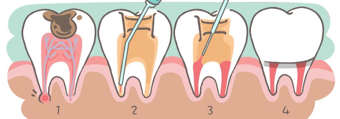 根管治疗后牙裂了还可以做牙冠吗,根管治疗后戴牙冠有什么利弊