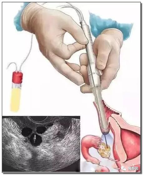 纽约通过合法代孕！中国女性千万要注意，代孕已经毁了很多女孩。