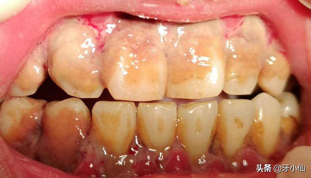 牙龈出血口臭跟牙齿不贴合,有个牙齿晃动牙龈出血口臭