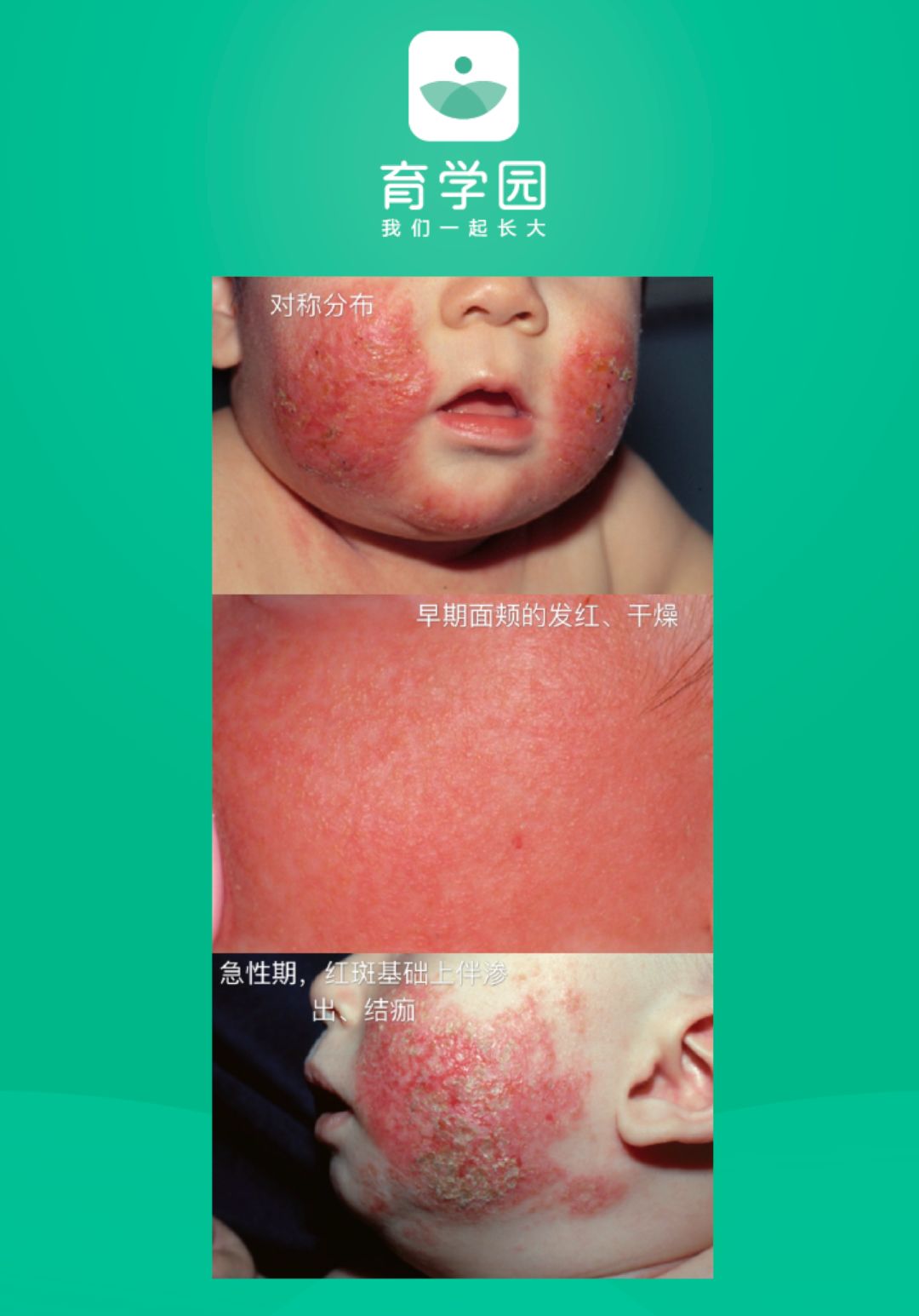 宝宝皮肤发红疹怎么办,宝宝皮肤发红粗糙还痒怎么回事