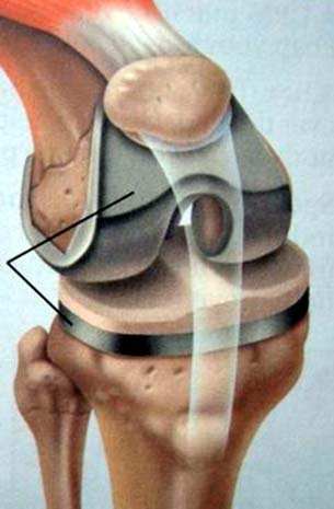 膝盖疼、老寒腿、长骨刺，关节炎了怎么办？45个短问，彻底讲清