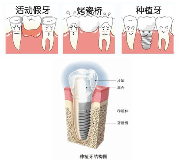 30岁种牙好还是镶牙好,我30岁了到底该不该整牙