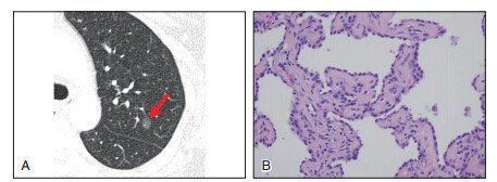 肺CT报告中的肺结节GGO是什么东西？到底是不是癌？