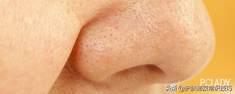 油性皮肤毛孔粗大怎么改善男,油性皮肤做点阵激光恢复快么