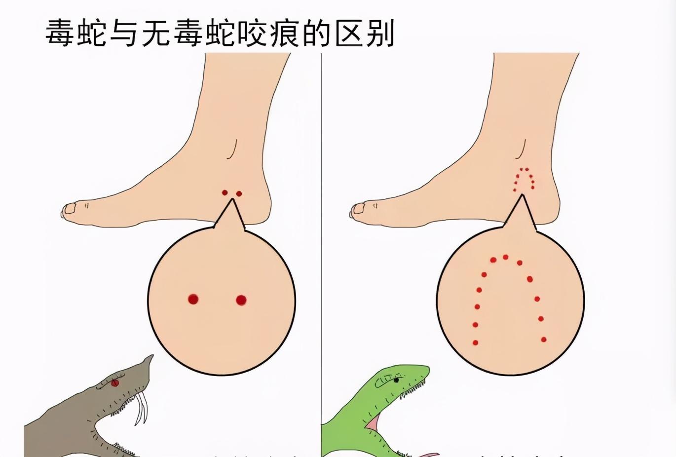 女子被毒蛇咬伤意识模糊,女子被蛇咬伤后竟没了心跳