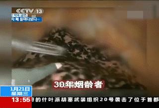 吸烟30年的肺戒烟后的变化,戒烟以后多久肺会恢复变白