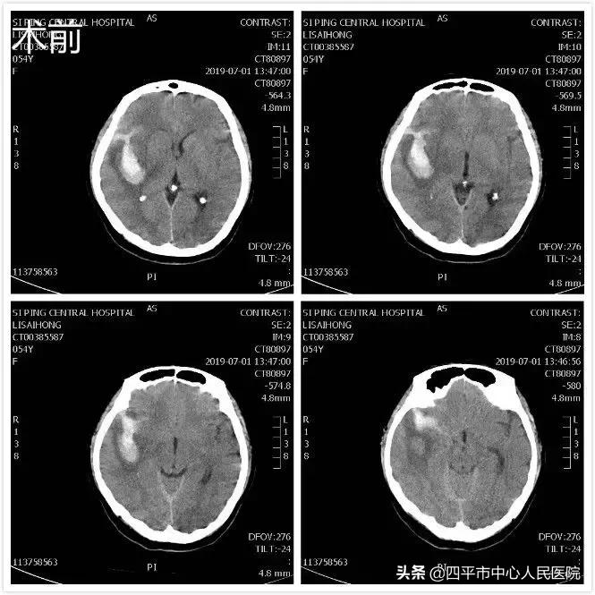 精准排雷再现新高—神经外科在6月份成功救治6例颅内动脉瘤患者