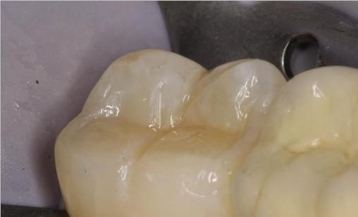 蛀牙补牙的材料基本就这些了,看你要怎么选