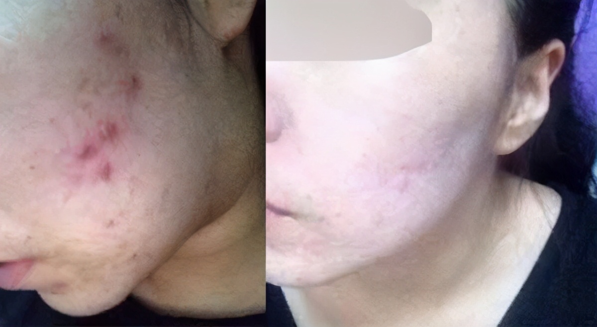 让青春痘从你脸上消失,青春痘真的可以延缓衰老么