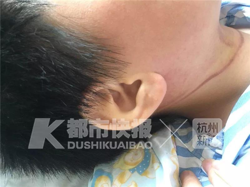 女童被绳子勒脖,儿童被绳索勒脖事件