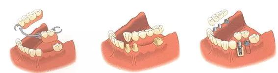 缺牙真的伤不起,缺牙对你最大的影响