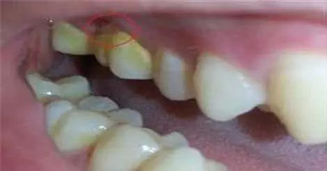 牙齿多久不刷会形成牙垢,牙齿背面没刷可以吗