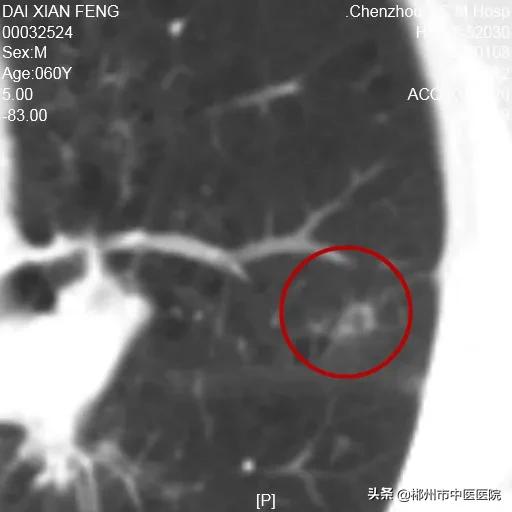 肺癌陀螺刀放疗后五年生存率,得了肺癌是不是不要轻易动手术