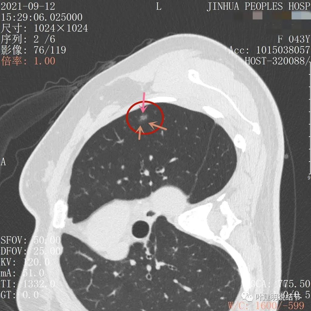 从活检怎么看是非小细胞癌,从病例谈辨证论治