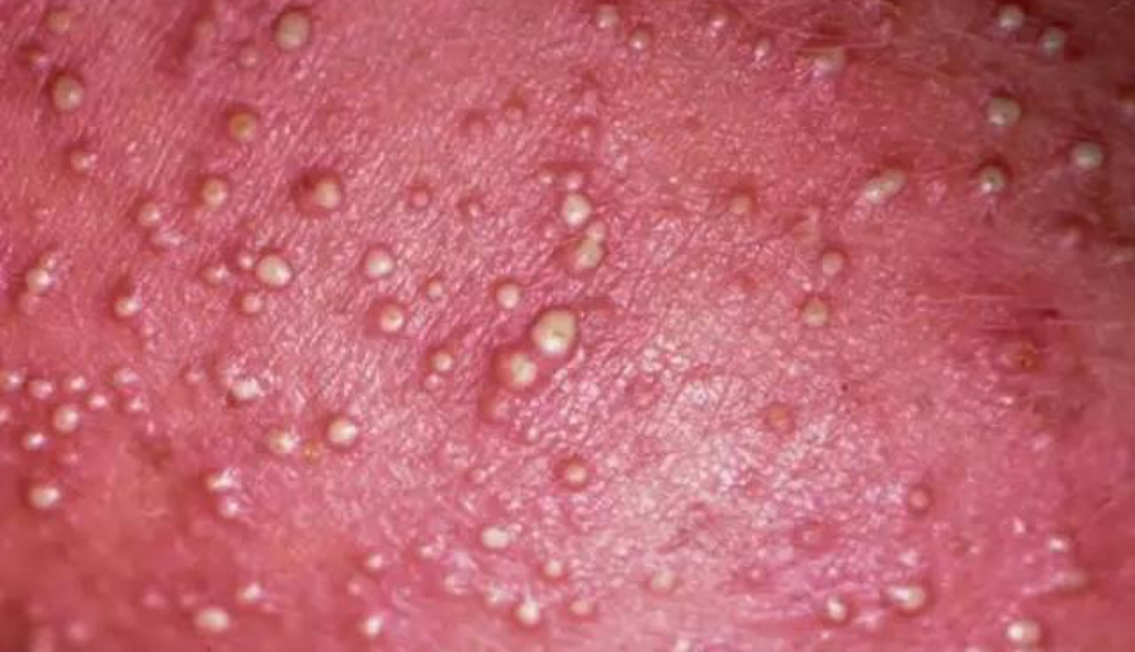 宝宝脂溢性湿疹可以涂什么药膏,宝宝湿疹脂溢性皮炎