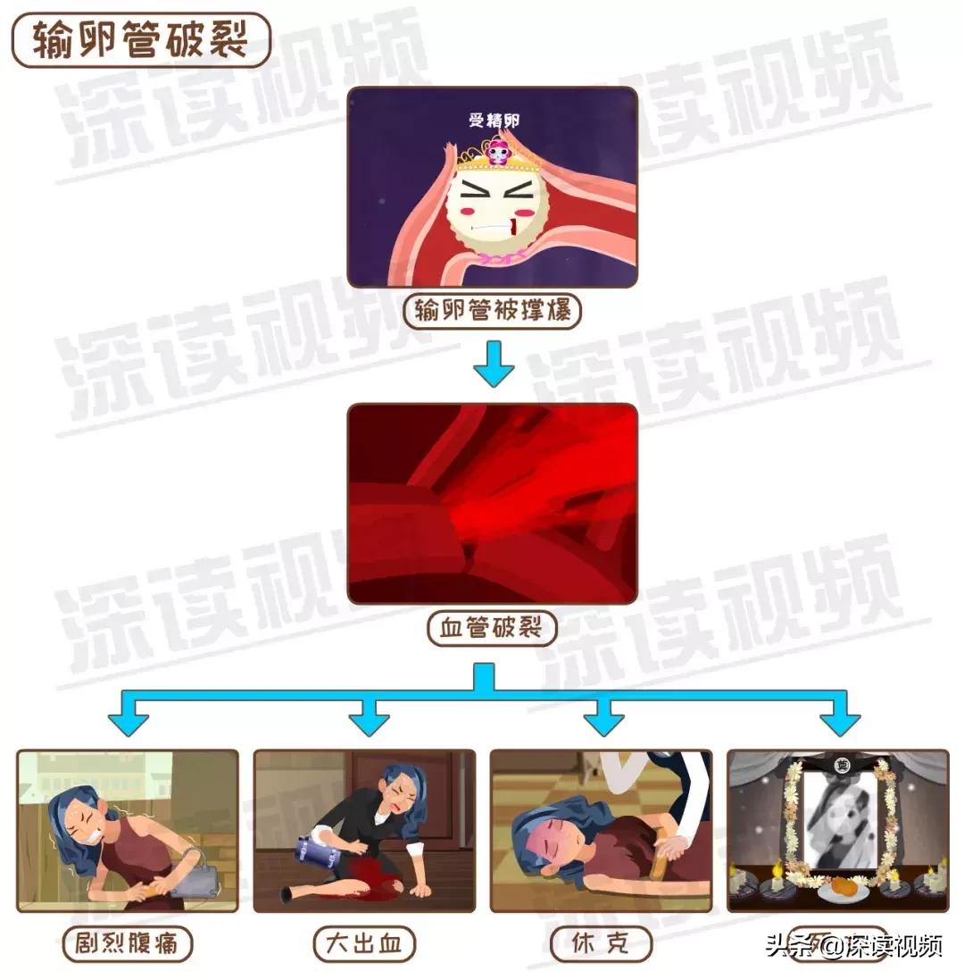 宫外孕有哪些习惯,怎样不容易宫外孕