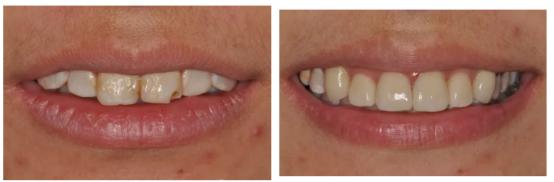 一口黄牙怎么办？10年牙科医生教你怎么拥有一口亮白美牙