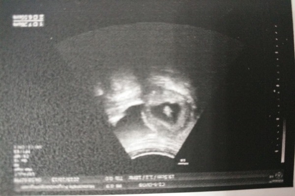 孕妇能做b超会不会伤宝宝,孕期b超检查都是阴超么