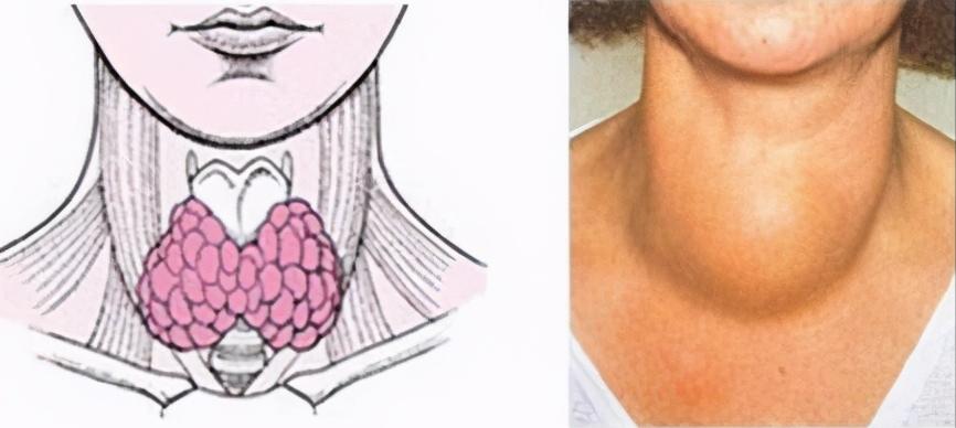 脖子粗斜方肌不对称,脖子粗大和甲状腺结节的区别
