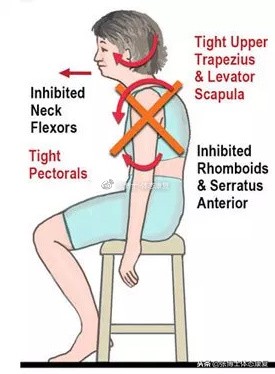 「体态矫正」手臂麻木疼痛，可能与第一肋骨上提移位有关