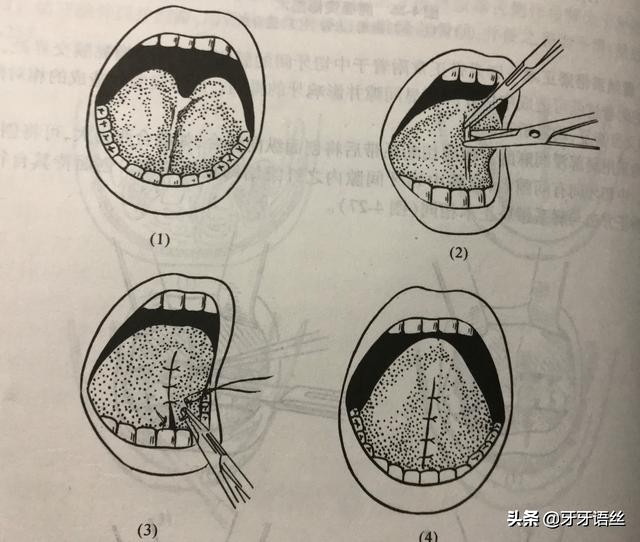 舌系带短会导致孩子不说话么,舌系带过短会影响孩子发音不准吗