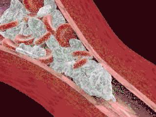 发生急性心梗吃什么药,突发急性心梗的急救措施流程