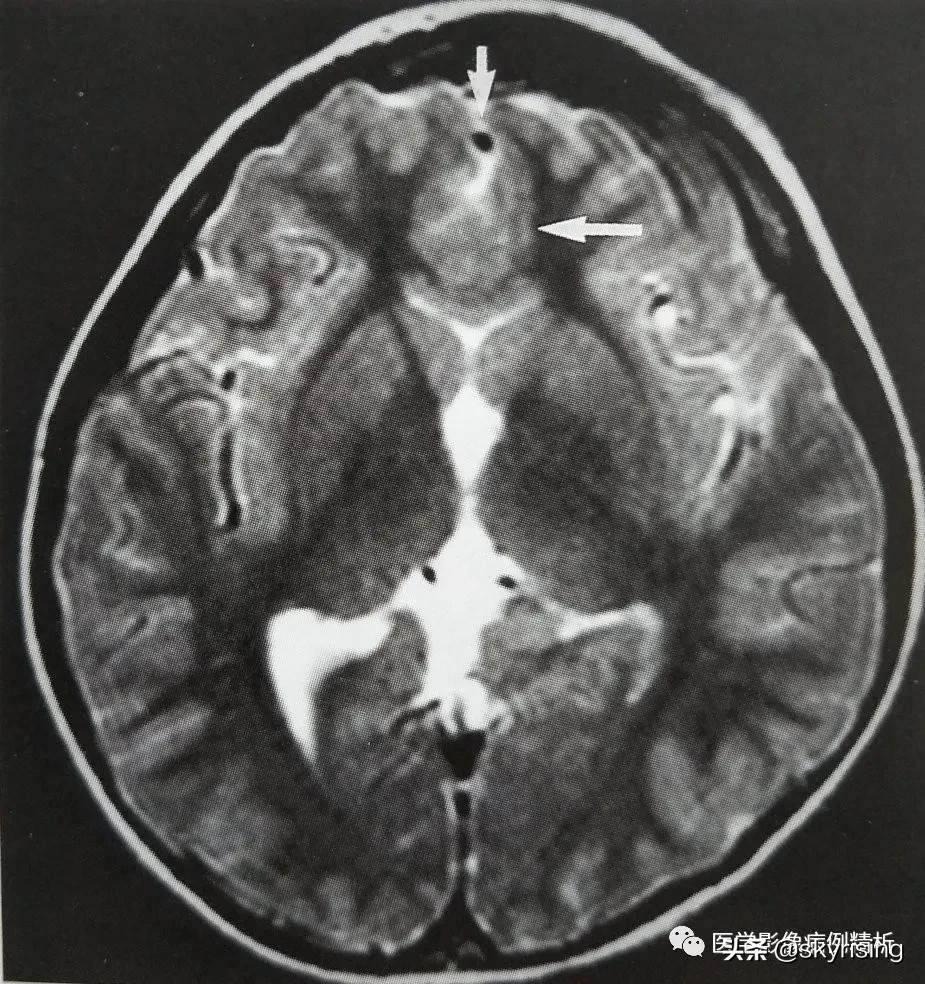 半叶全前脑畸形,无叶型前脑无裂畸形超声表现