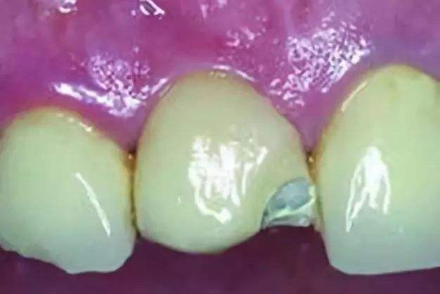 做烤瓷牙后现在全坏了怎么办,烤瓷牙一般多久需要更换