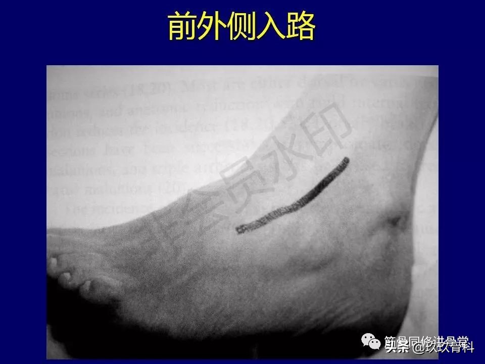 距骨骨折后遗症,距骨骨折怎么办