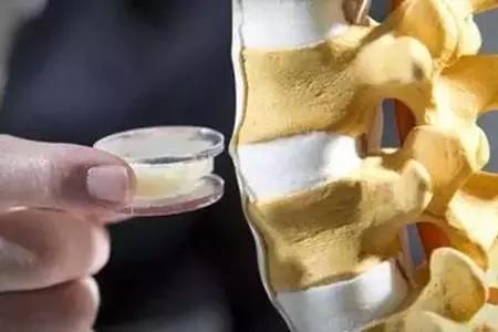 关节强直怎么治疗最好,强直髋关节如何保守治疗