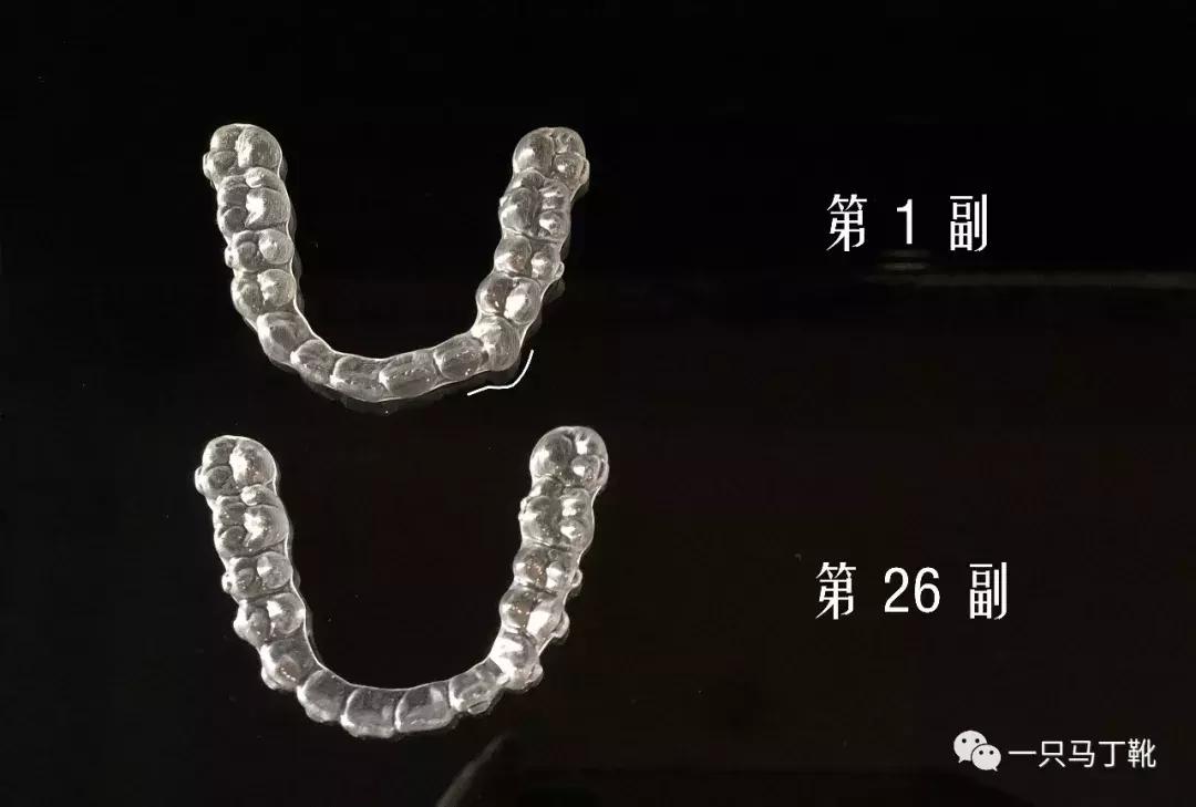 整牙给你点靠谱的建议,整牙亲身经历经验分享