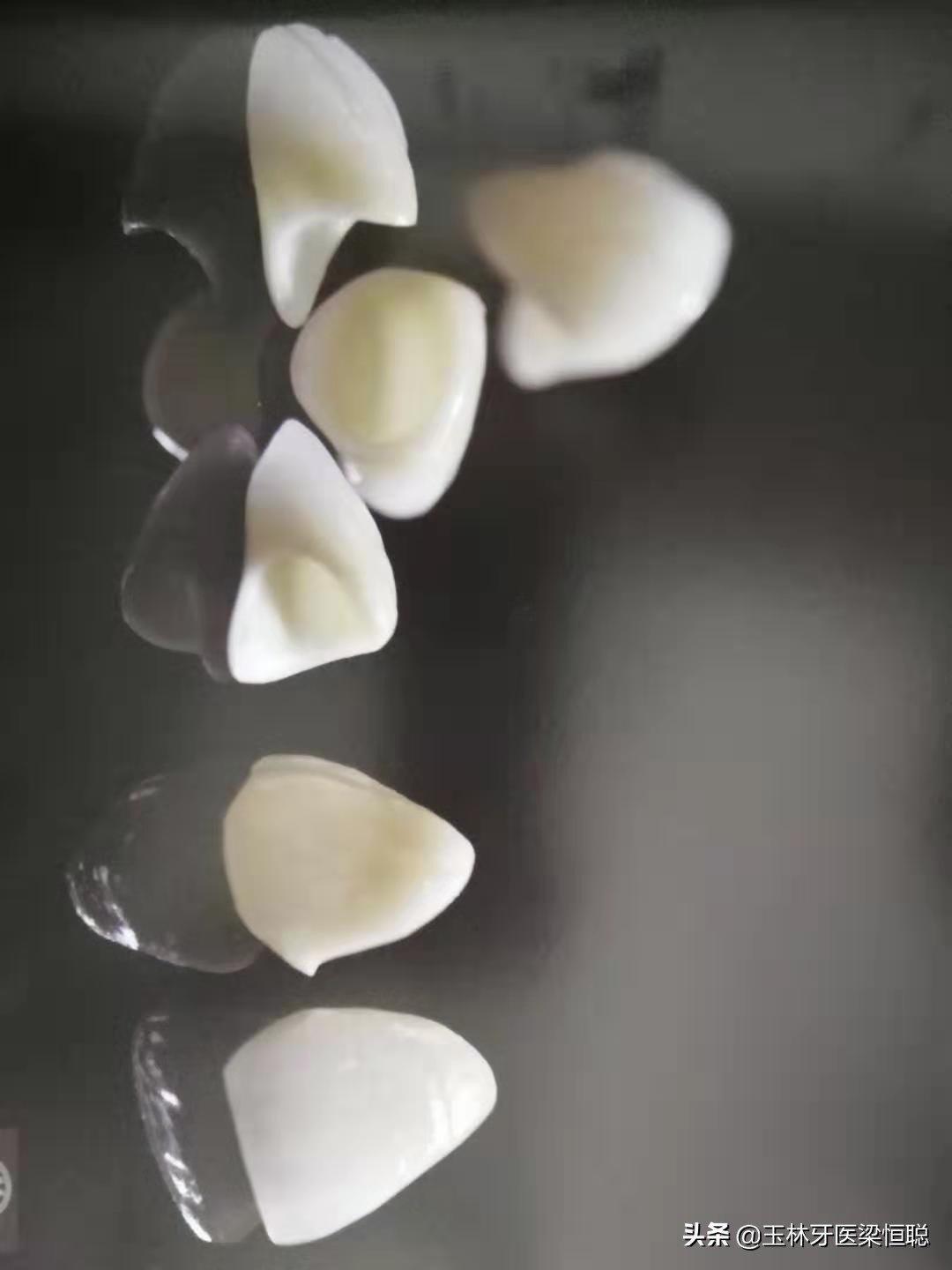 如何选择烤瓷牙牙冠,怎样选烤瓷全冠