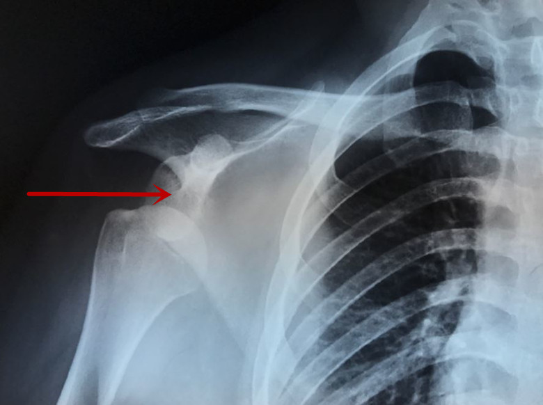 肩膀疑似脱位但是ct显示正常,肩关节脱位术后又翘起来了