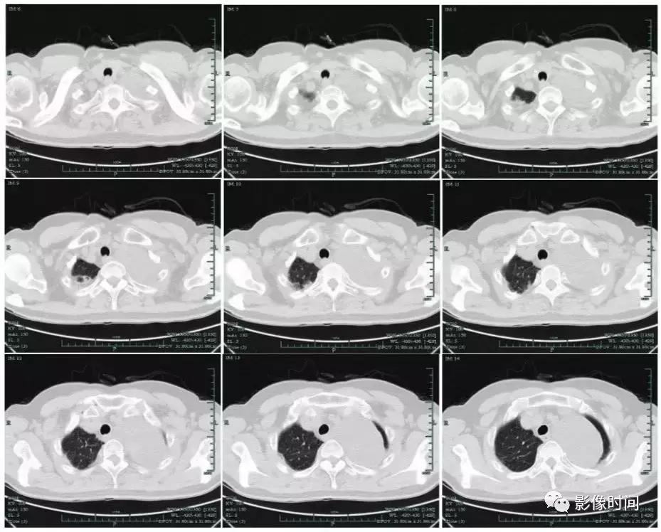 体检发现纵隔囊肿必须治疗吗,体检发现巨大纵隔肿物怎么办