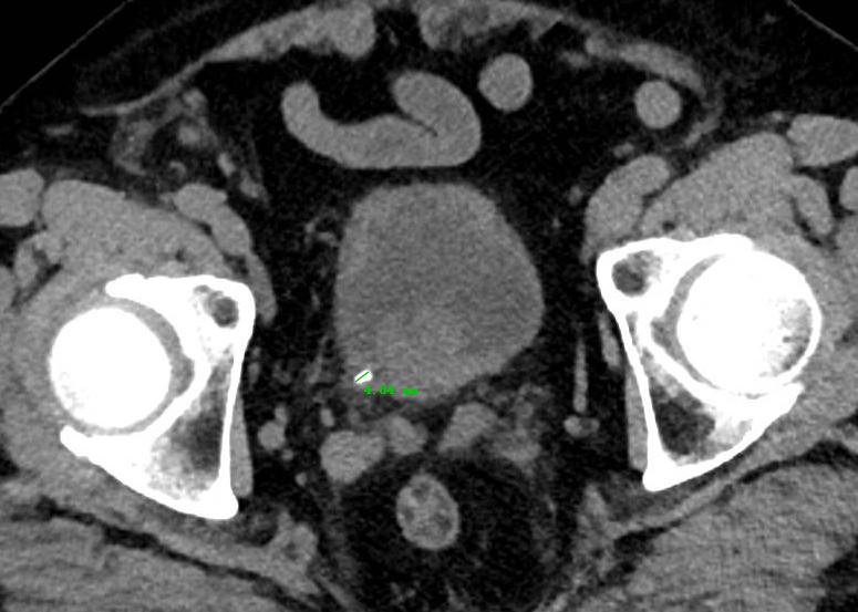 最新输尿管结石的治疗方法,输尿管结石的药物治疗