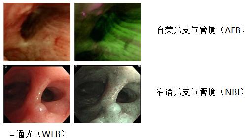 孙加源门诊,治疗肺癌的新技术新手段