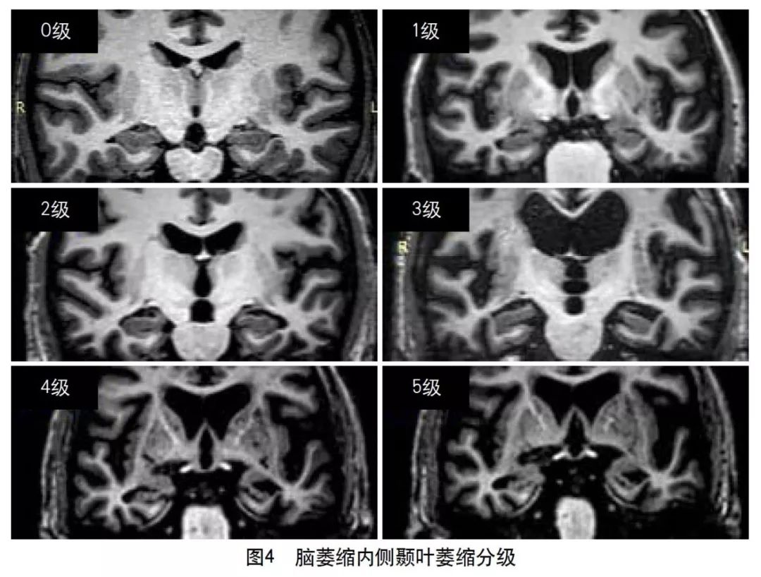 脑血管病影像诊断大全汇总,脑小血管病变影像学表现