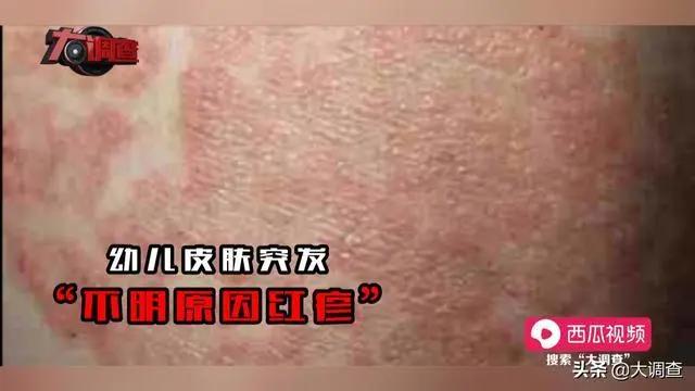 喝三聚氰胺奶粉的大头娃娃,湖南婴儿喝奶粉成大头娃娃