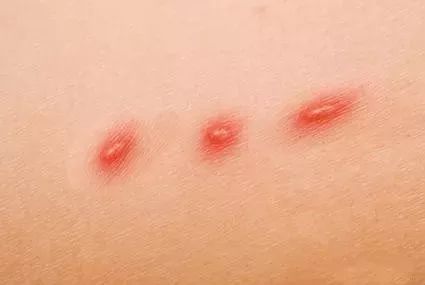 辟谣:养猫会得猫抓热?猫抓热到底是什么病?你家猫咪患上了吗?