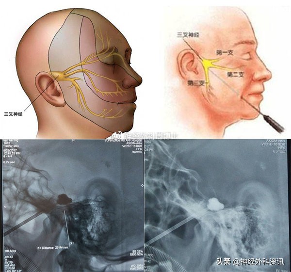 三叉神经痛不治疗有什么不良预后,三叉神经痛不做手术怎么能治疗好