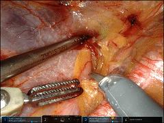 阴道莫名出血,注意了!所幸无转移