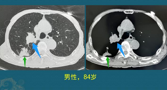 吃什么抗肺癌防癌最好,老年人肺癌晚期治疗成功案例