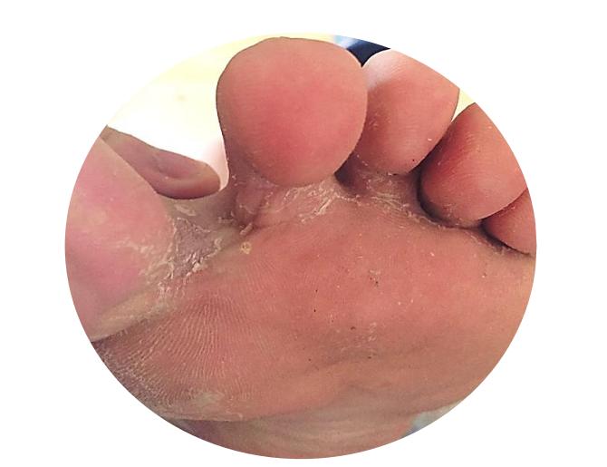 家里治脚气最好的方法,家庭治脚气的最好方法