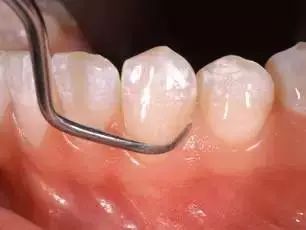 普通洗牙和舒适化洗牙有什么区别,一般洗牙和深度洗牙区别