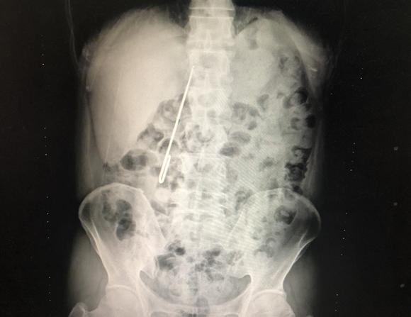 男子与妻子拌嘴一气之下吞16公分长针