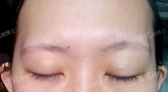 原来双眼皮不好看有必要继续割吗,割双眼皮是不是越修复越难看