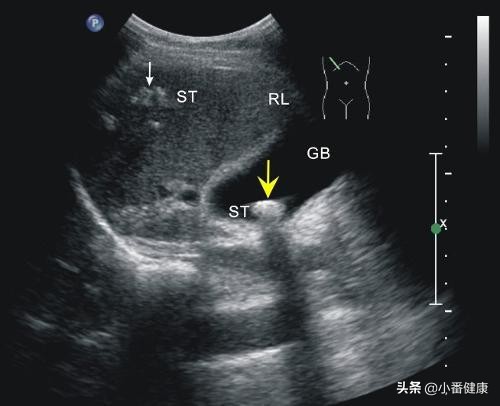 转氨酶高排除乙肝还需要查什么,谷丙转氨酶偏高是否能确定有乙肝
